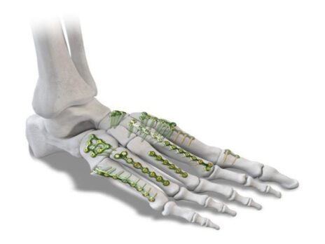Paragon 28 introduces new small bone fixation system for foot and ankle