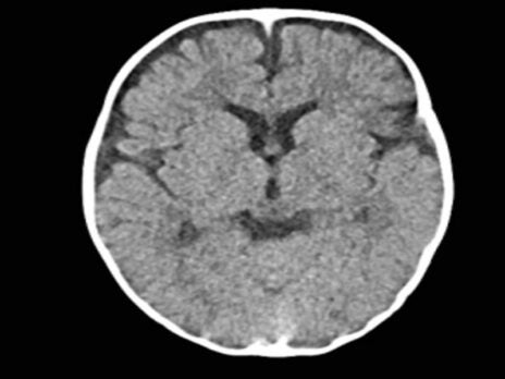 Radiation from CT scans can increase risk of brain cancer in children