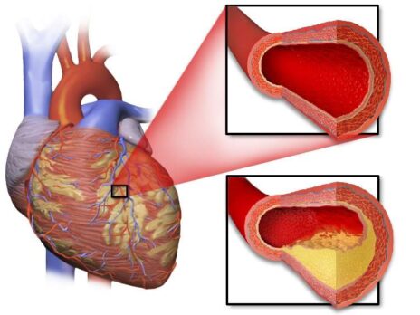 NHS adopts HeartFlow’s AI technology to tackle coronary heart disease