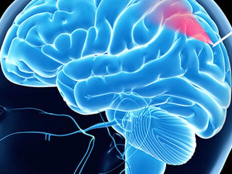 Australian researchers test new needle to reduce brain bleed risk