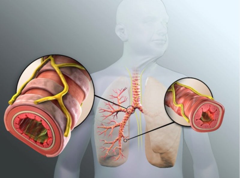 Nuvaira secures funds to develop lung denervation system