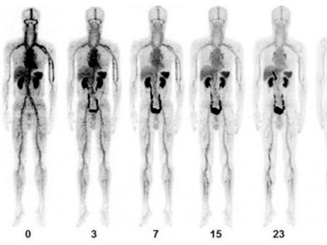 PET/CT agent could improve acute venous thromboembolism diagnosis