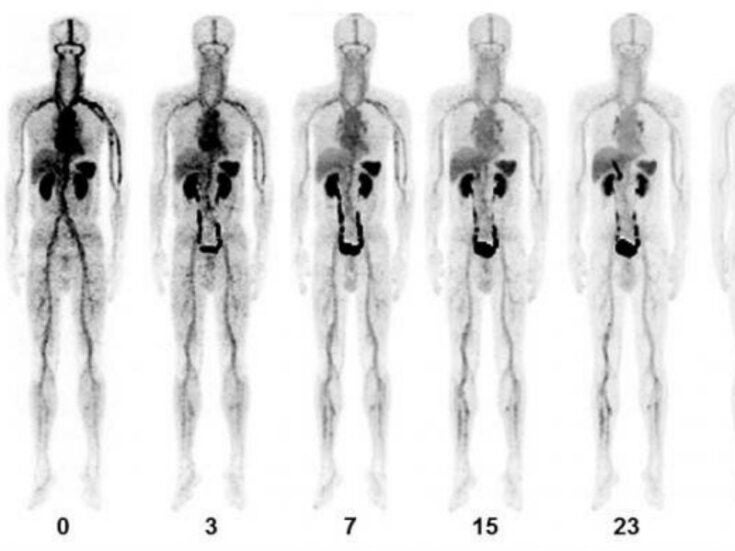 PET/CT agent could improve acute venous thromboembolism diagnosis