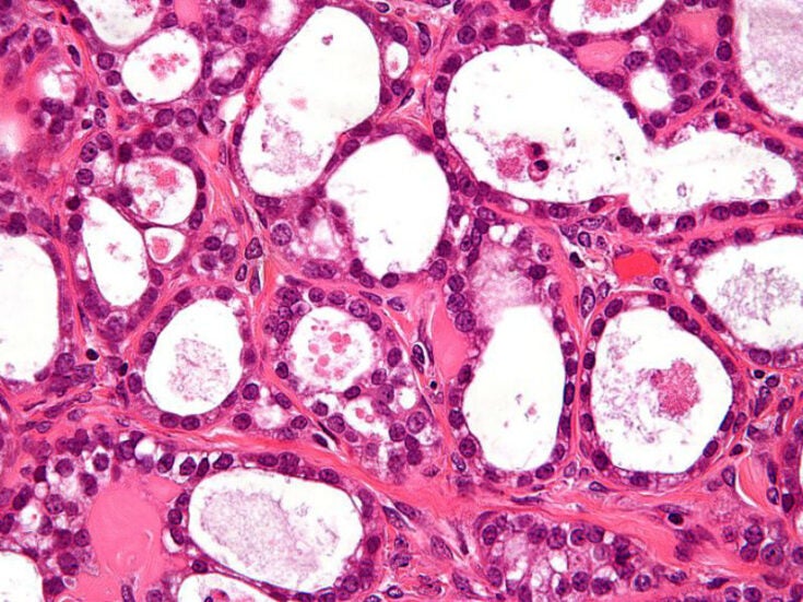Artificial intelligence predicts ovarian cancer patients’ survival rate