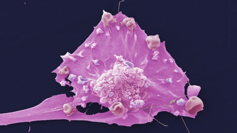 Researchers identify molecular patterns to predict breast cancer return