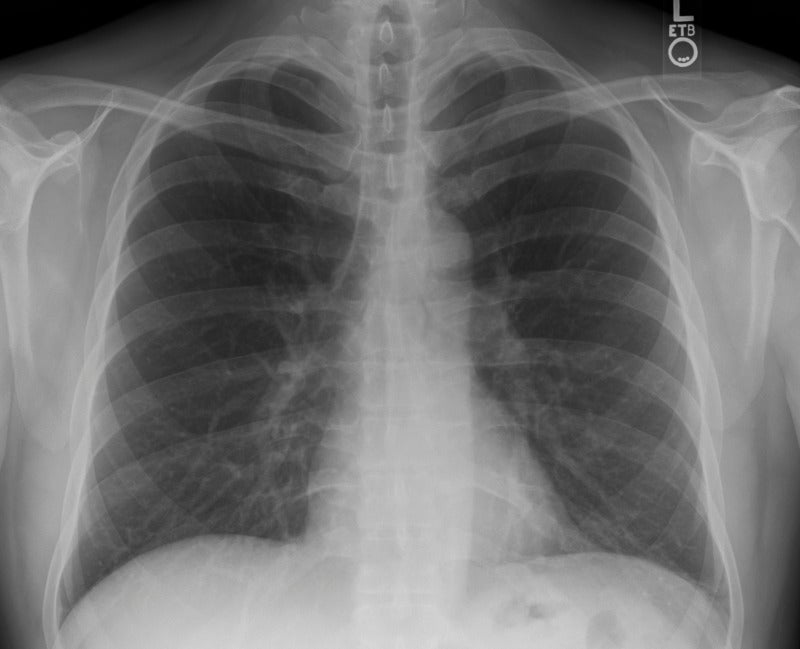 AI technology analyses chest X-rays for long-term mortality