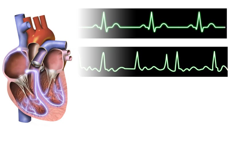 Mayo Clinic tests AI to detect atrial fibrillation