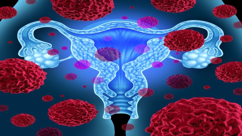 New test to detect ovarian cancer two years earlier