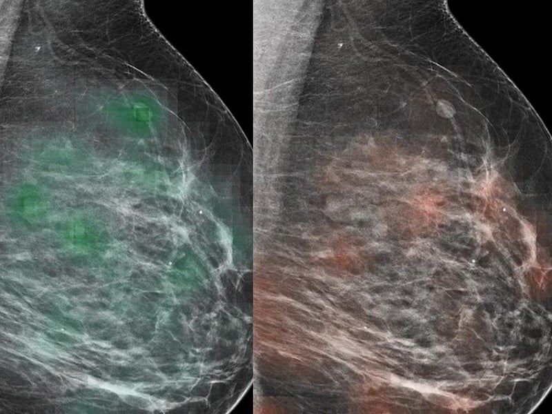 breast cancer ai imaging