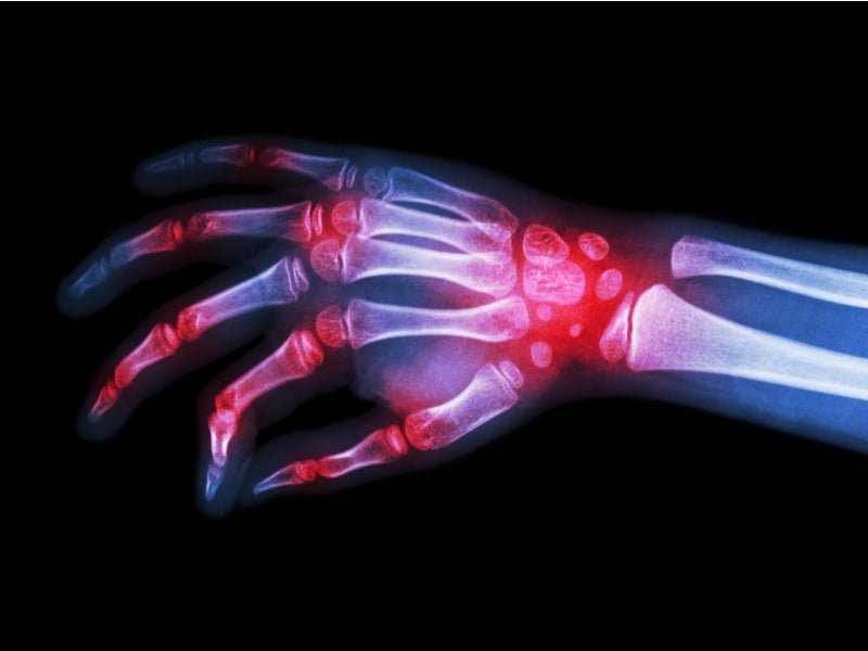 arthritis thermal imaging