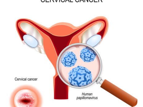New screening method for cervical cancer may improve early diagnosis
