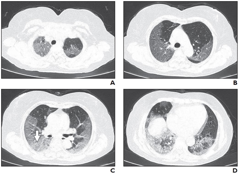 Lungs after covid