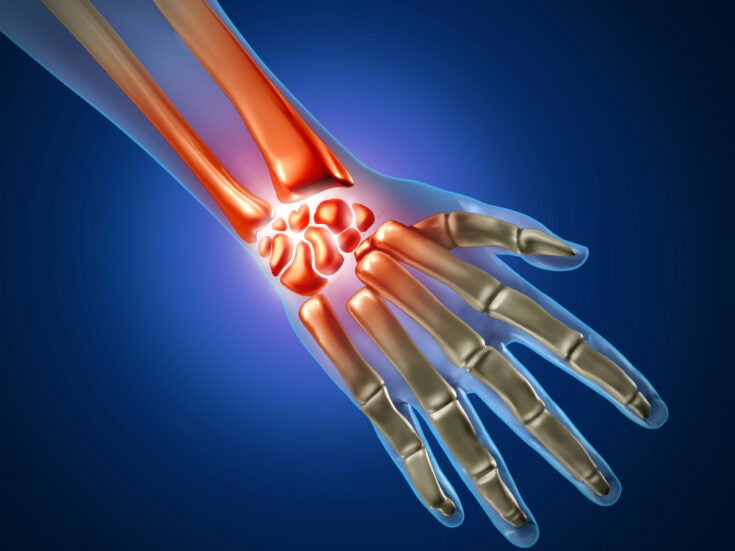 Anika receives FDA clearance for wrist joint restoration system