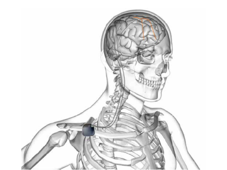 Medical devices in-depth product overview: deep brain stimulation systems