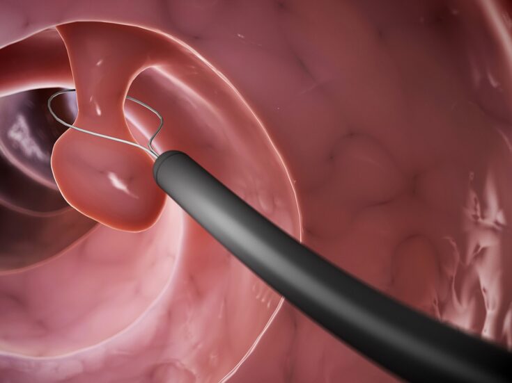 FDA clears Olympus’ NBI to characterise colorectal polyps potential