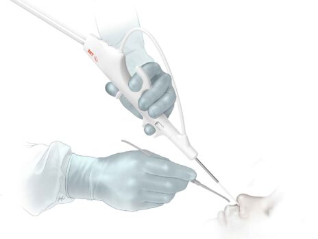 FDA approves 3NT Medical’s single-use sinus endoscope