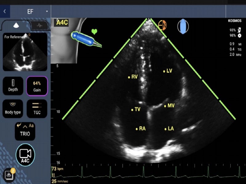 Point of Care Ultrasound Technology (POCUS) With AI