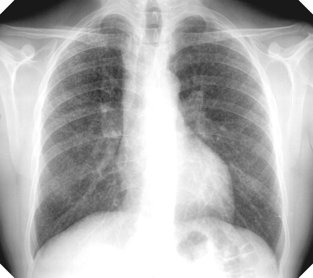Lung disease caused by silica dust