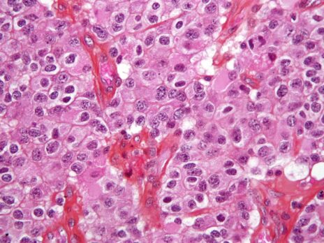 University of Sussex researchers to develop brain tumour diagnosis test