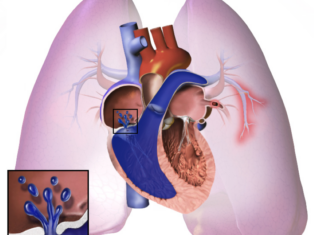 Anumana’s AI tool for pulmonary hypertension gets FDA breakthrough status