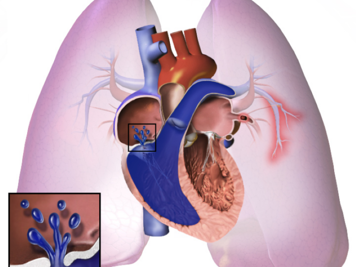 Anumana’s AI tool for pulmonary hypertension gets FDA breakthrough status