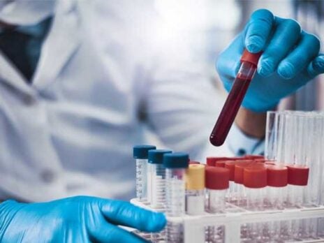 Labcorp introduces blood test to detect neurodegenerative disease