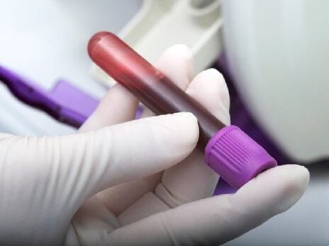 University of Bristol to develop simple blood test for brain tumours