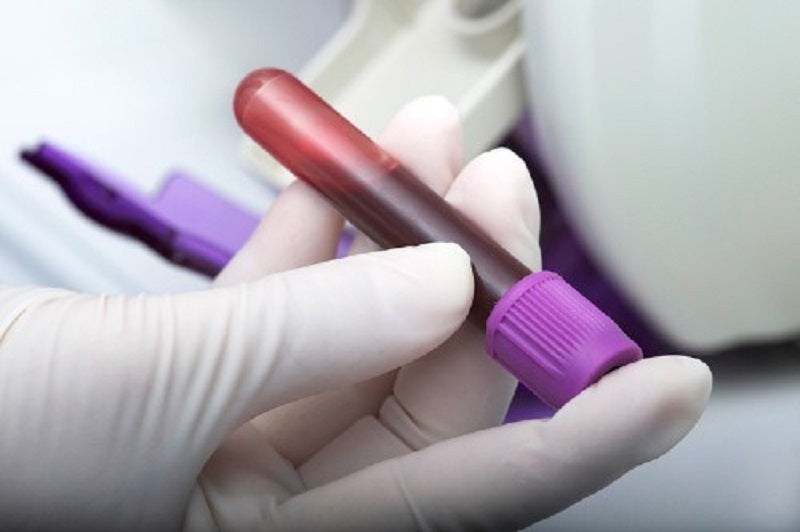 University of Bristol to develop simple blood test for brain tumours