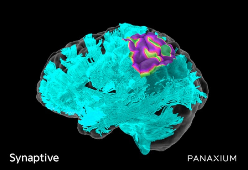 Synaptive Medical and Panaxium partner for real-time cortical mapping