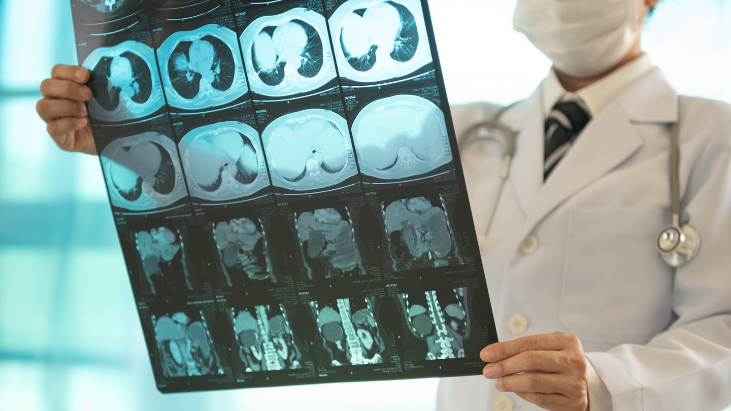 AngioDynamics expands European indications for NanoKnife system 