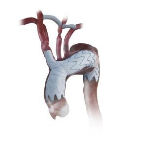 NEXUS Aortic Arch Stent Graft System