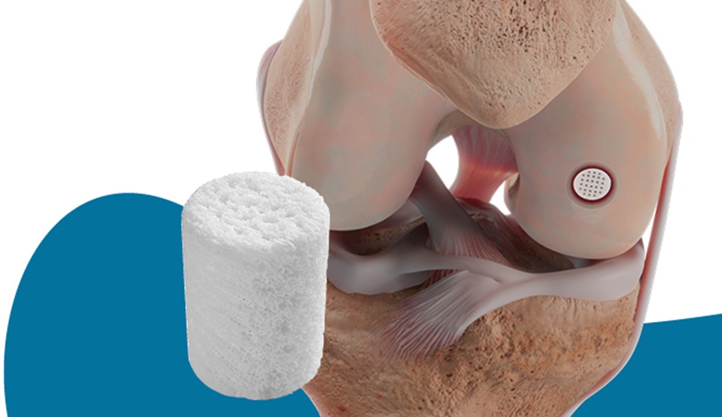 Smith+Nephew’s cartilage implant achieves higher KOOS score