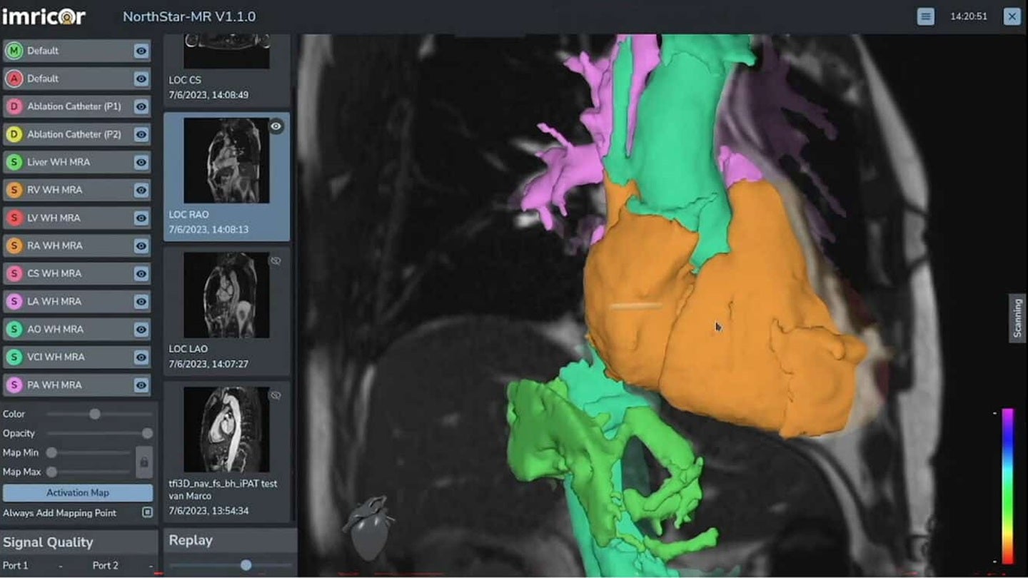 Imricor begins US commercial sales of NorthStar mapping system