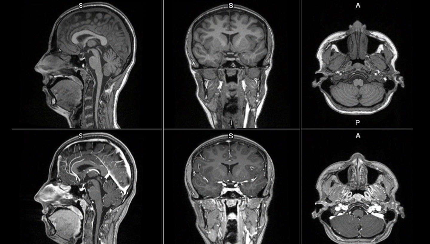 First patient dosed in GE HealthCare’s Phase II/III LUMINA clinical trial