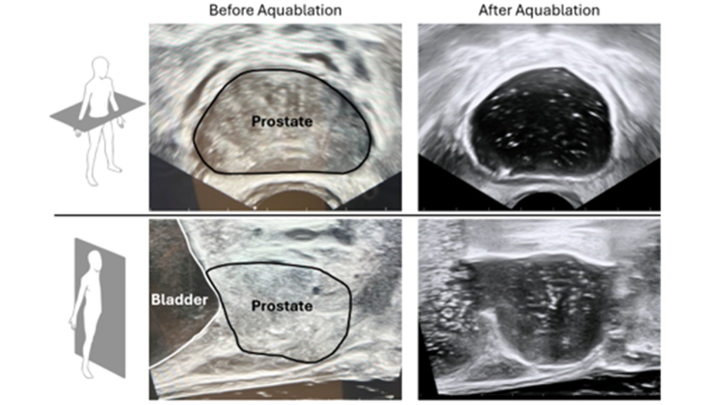 Procept secures FDA IDE for Aquablation and completes WATER IV study enrolment
