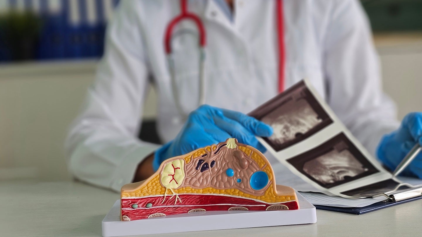 BCAL Diagnostics develops blood test to evaluate breast cancer