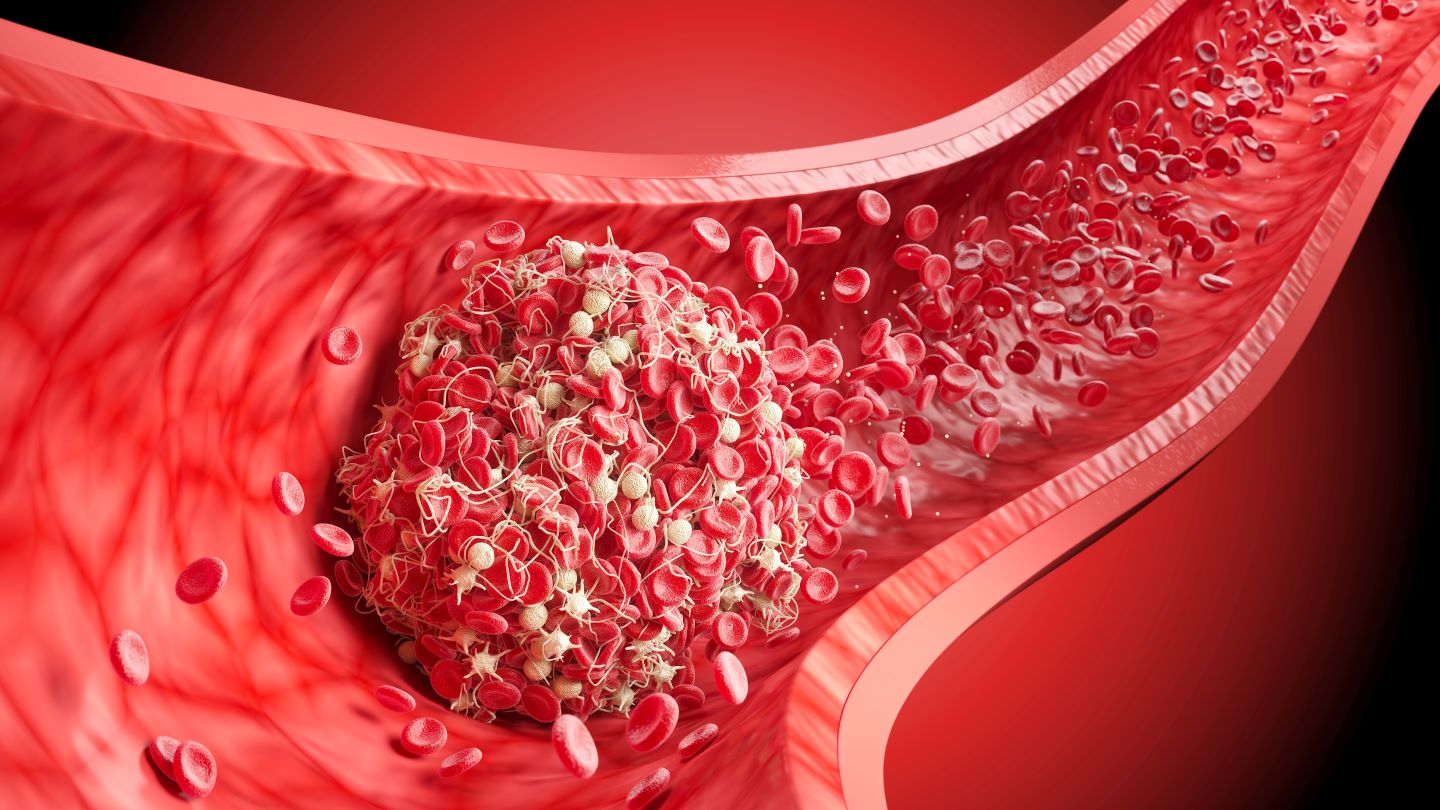 FDA clears Penumbra’s Thunderbolt thrombectomy platform for stroke