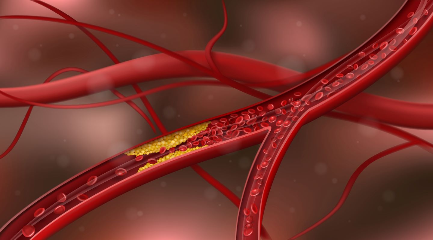 ESC 2026: Identifying ‘silent’ atherosclerosis may help reduce global CVD burden