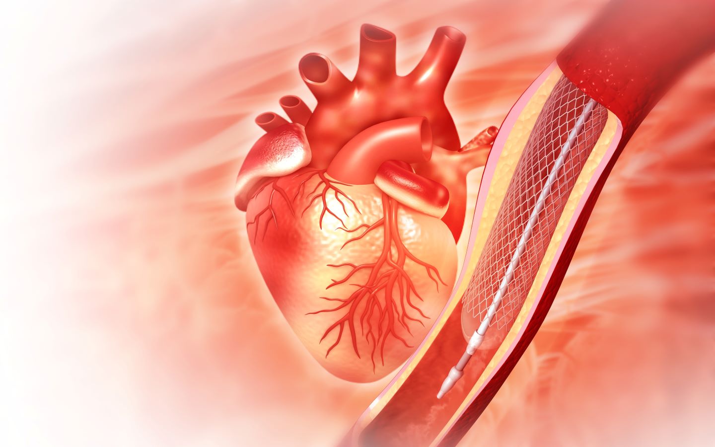 ESC 2026: Heartflow’s fractional flow reserve tool reduces unnecessary coronary interventions