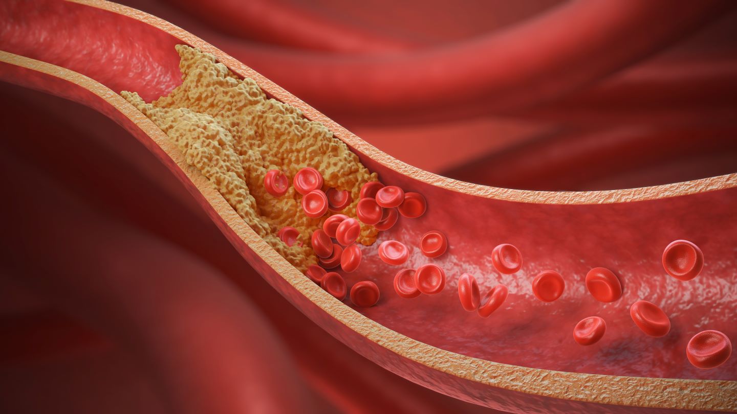 Elucid raises $55m to advance cardiovascular diagnostic portfolio