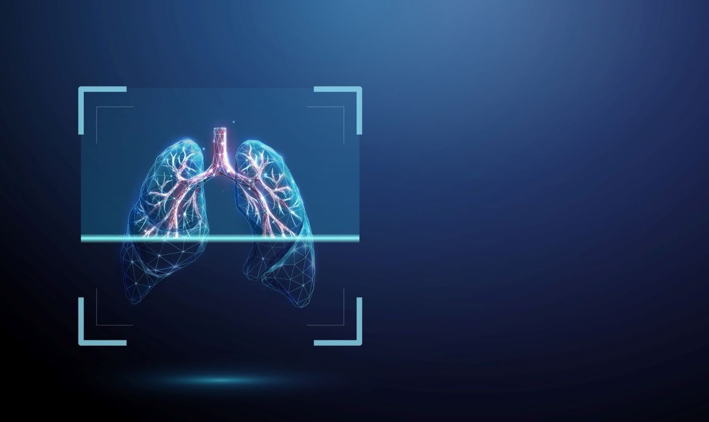ERS 2026: AI lung imaging shows utility in detecting pulmonary fibrosis candidate’s efficacy