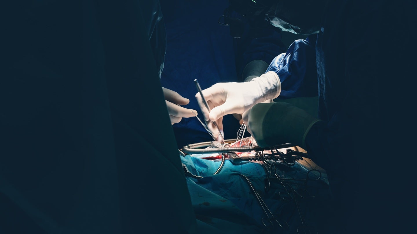First US commercial procedures completed with Emboline’s device